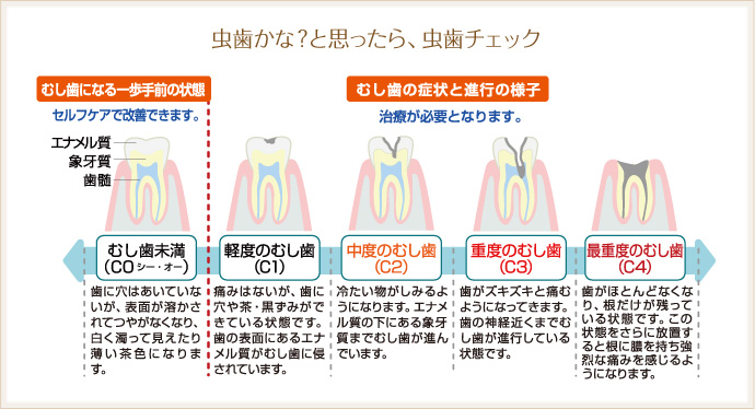 虫歯かな？と思ったら、虫歯チェック