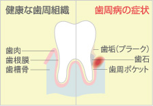 歯周病の症状