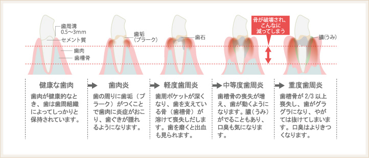 歯周病の症状と進行の様子