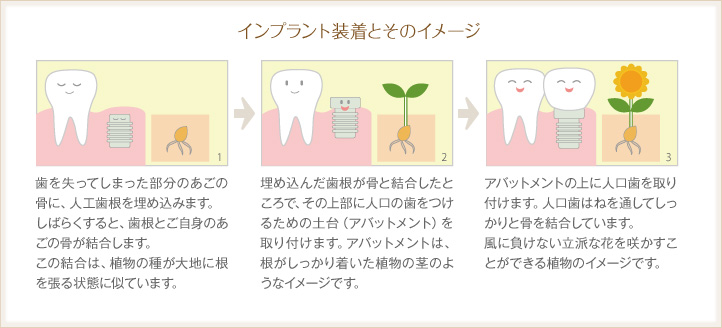 インプラント装着とそのイメージ